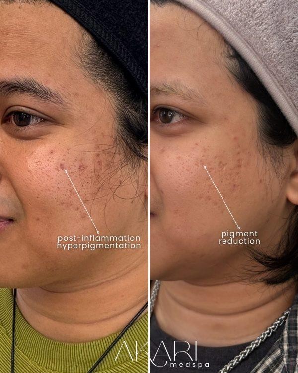 Results: What Kind of Improvements Can You Expect from Microneedling With PRP