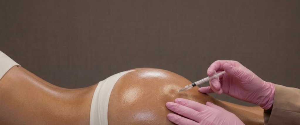 What Is a Non-Surgical Brazilian Butt Lift?