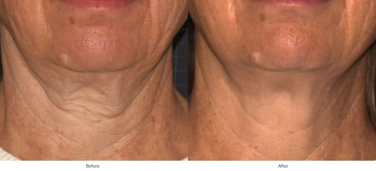 sofwavetm-treatment-newport-beach-pasadena-before-after1