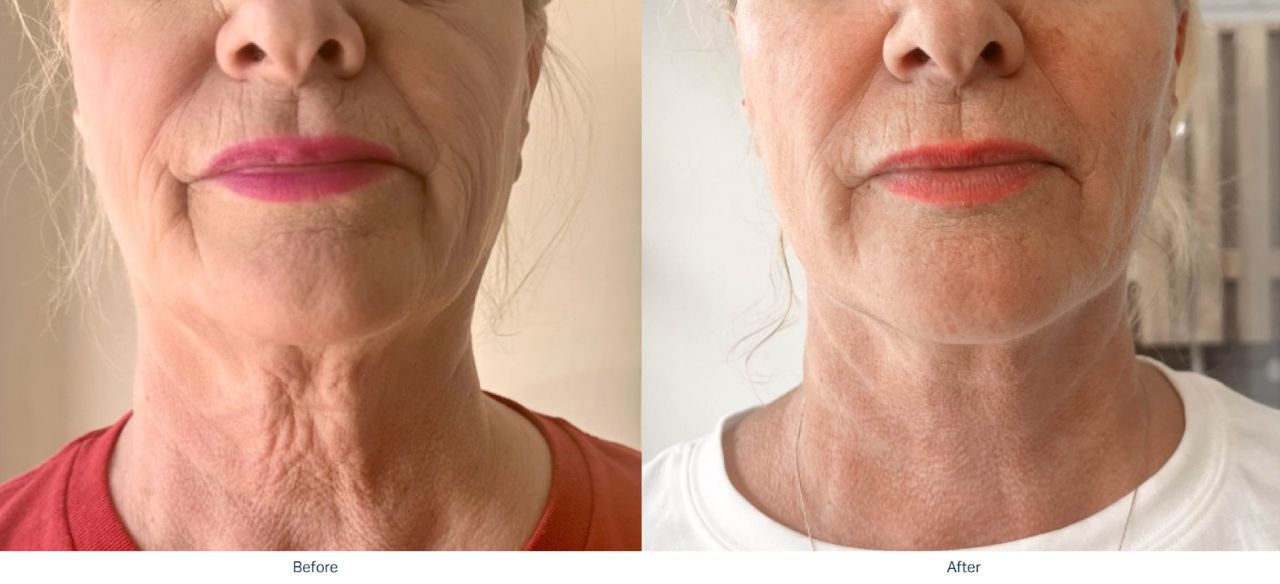 Sofwave™ Treatment Newport Beach and Pasadena - Before & After