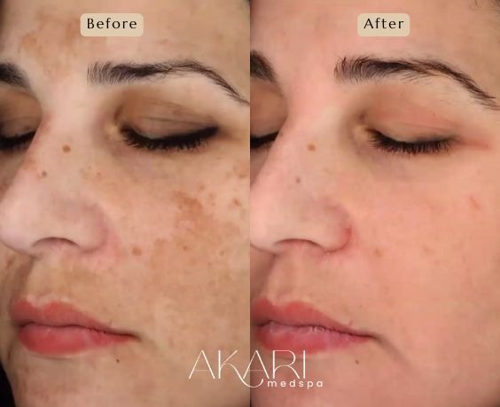 Cosmelan Peel Before & After: Newport Beach & Pasadena Guide