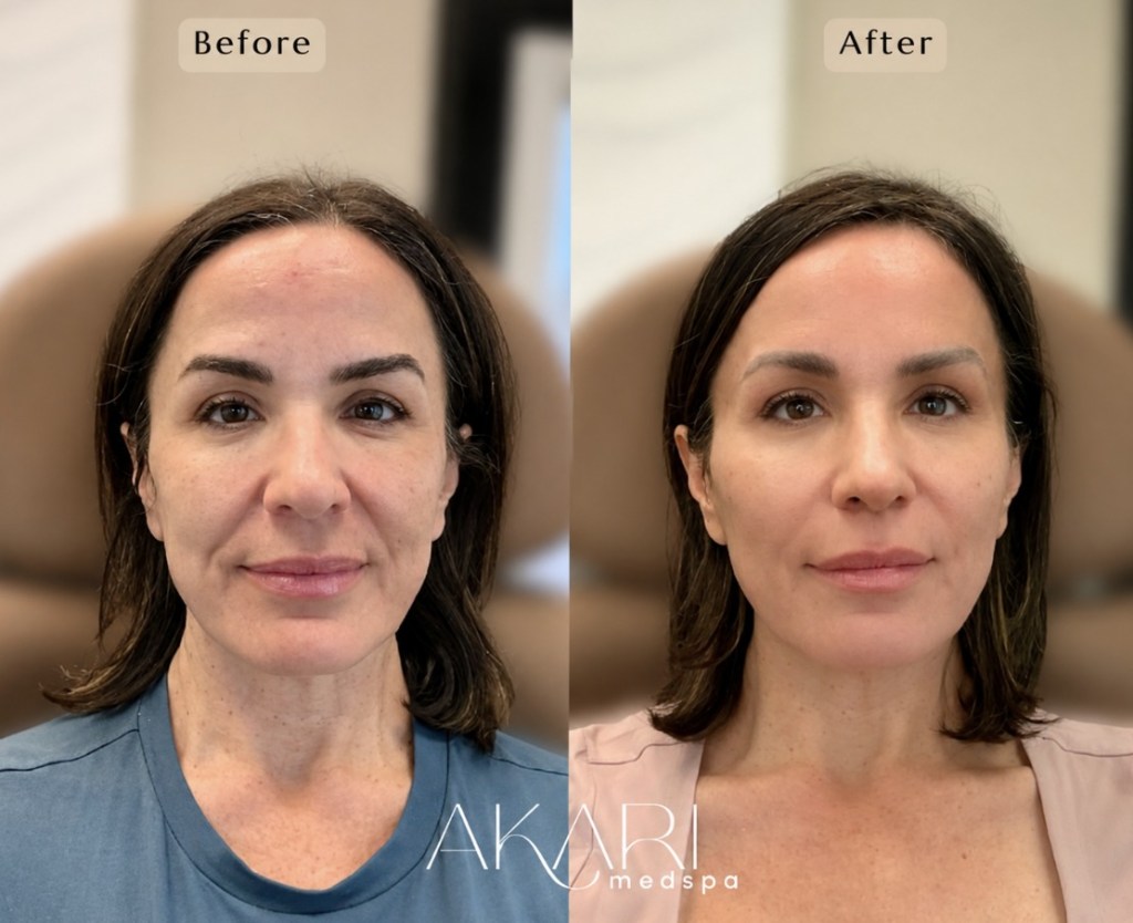 Facial Balancing Treatments Available at Akari Medspa